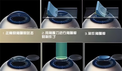 杭州華廈眼科醫(yī)院黃旭醫(yī)生smart全激光17800元，術(shù)后視力清晰穩(wěn)定