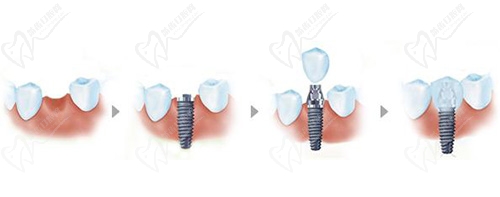 種植牙過(guò)程