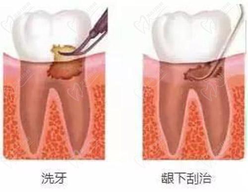 洗牙和齦下刮治