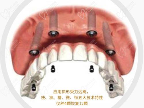 揚州金鉑利口腔種植技術