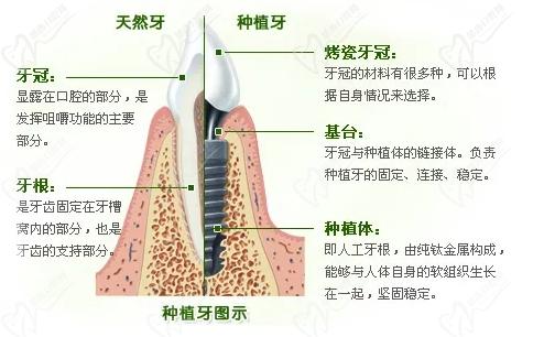 揚(yáng)州金伯利口腔種植牙靠譜