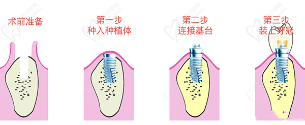 種植牙過程