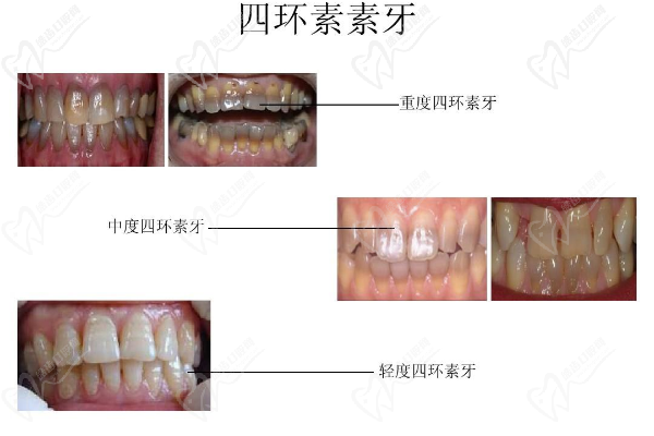 四環(huán)素牙是怎么回事