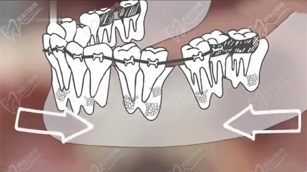 矯正牙根吸收