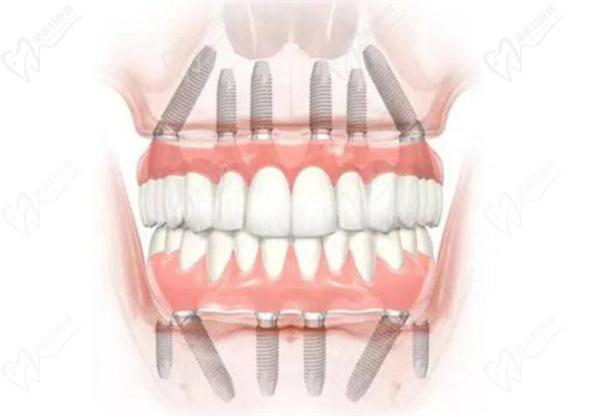 all-on-6種植牙