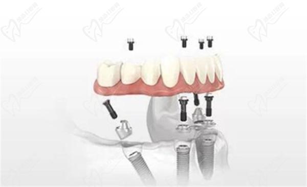 All-on-4種植牙