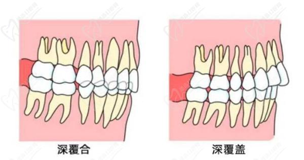 牙齒只深覆蓋正常嗎？深覆蓋有必要矯正嗎？看矯正后臉型變化