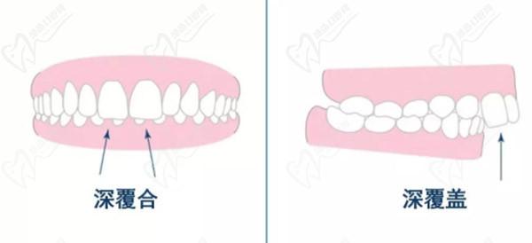 牙齒只深覆蓋正常嗎？深覆蓋有必要矯正嗎？看矯正后臉型變化