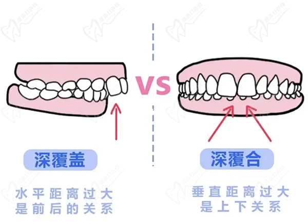 牙齒只深覆蓋正常嗎？深覆蓋有必要矯正嗎？看矯正后臉型變化