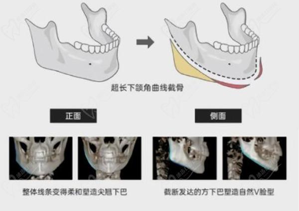 上海華美整形磨骨病例