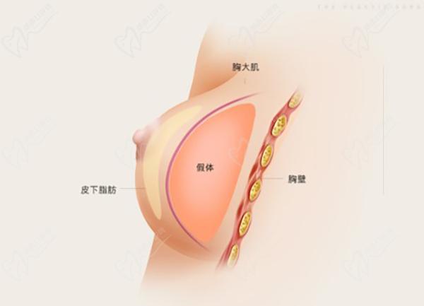 蘇州聶志宏隆胸手術(shù)價(jià)格