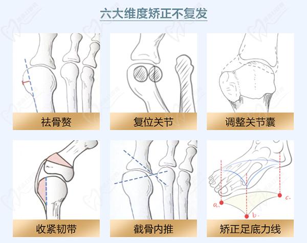 大腳骨拇外翻好的治療方法