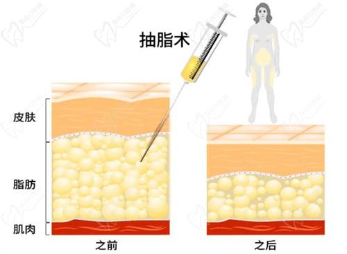 武漢中翰吸脂醫(yī)生推薦