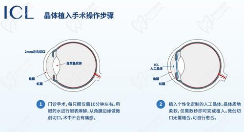 武漢愛爾眼科漢口醫(yī)院ICL晶體植入技術(shù)扎實(shí)