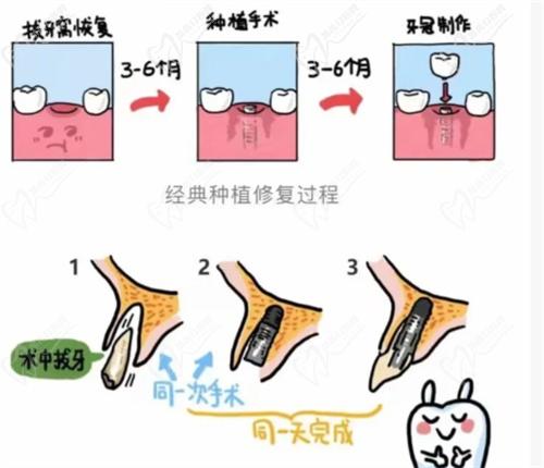 全口種植牙的優(yōu)勢