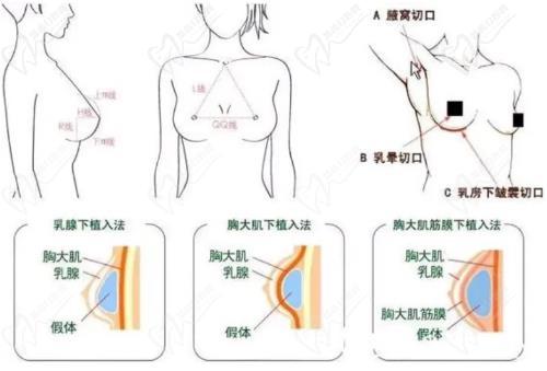 于雙全隆胸怎么樣