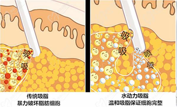 國內吸脂價格表