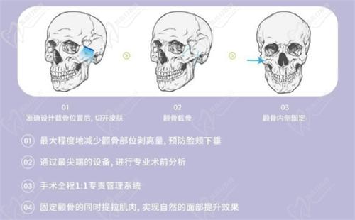 PSF三維立體截骨技術(shù)