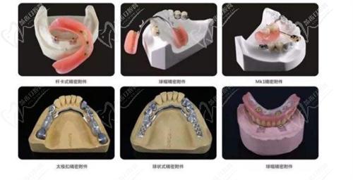 精密附著體和活動義齒的適應人群區(qū)別