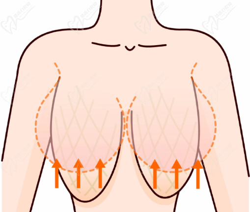 乳房縮小手術(shù)費(fèi)用多少錢