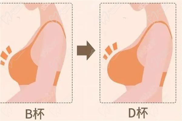 廈門林高萍豐胸