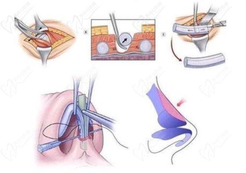 耳軟骨隆鼻有什么風(fēng)險和后遺癥？