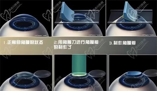 杭州華廈眼科醫(yī)院黃旭醫(yī)生smart全激光17800元，術(shù)后視力清晰穩(wěn)定